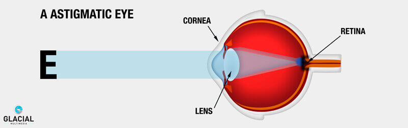 Diagram of an Astigmatic Eye
