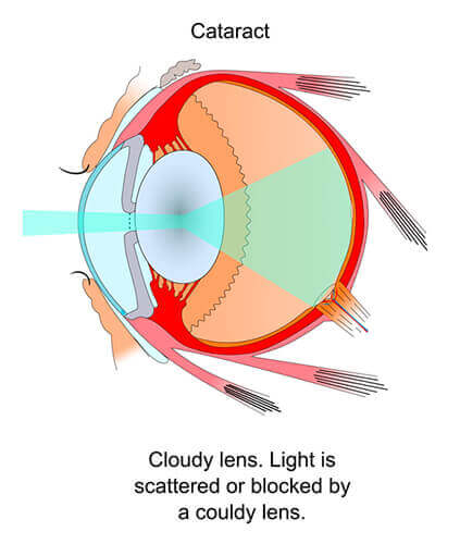 Diagram of an eye with cataract