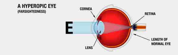 Hyperopic (farsighted) eye diagram