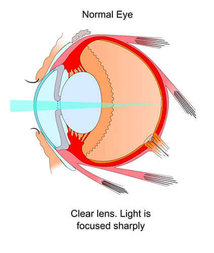 Diagram of a normal eye without cataract