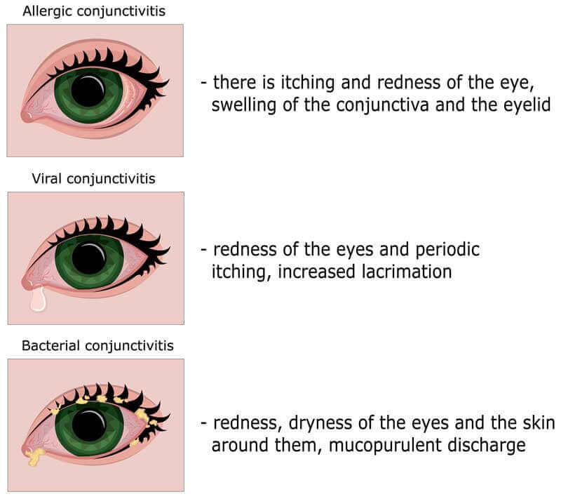 Types of Conjunctivitis chart